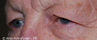 Image of patient before eyelid surgery, blepharoplasty